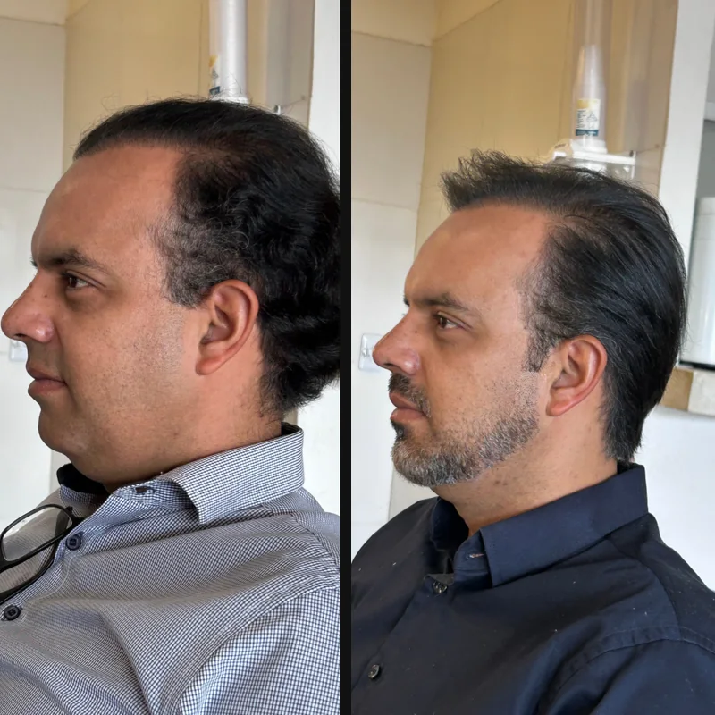 Antes e depois de perfil: cabelo e barba redesenhados
