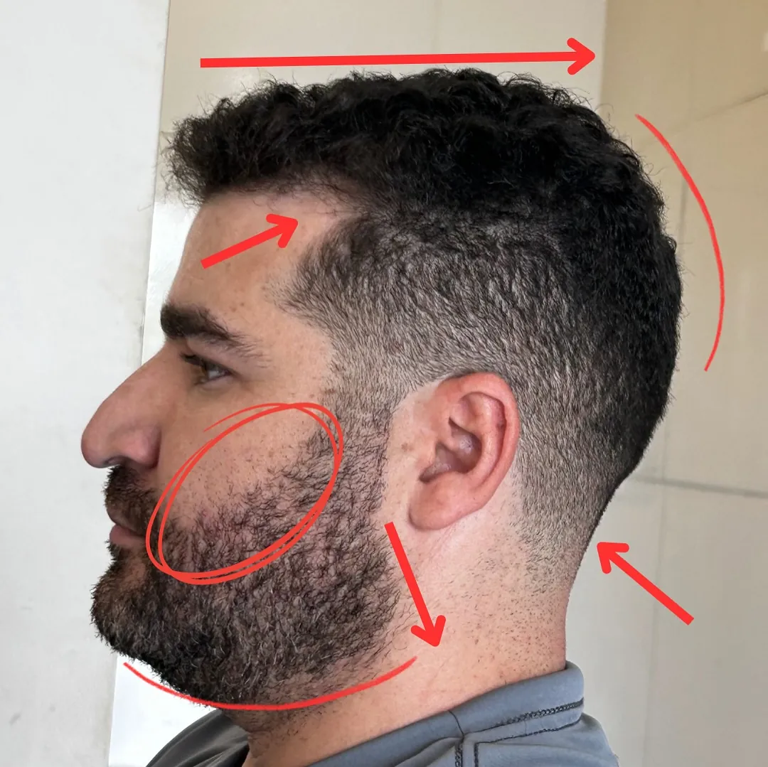 Antes: cliente de perfil com as marcações de diagnóstico do Daniel na barba e no volume